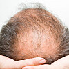 does baldness come from poor health