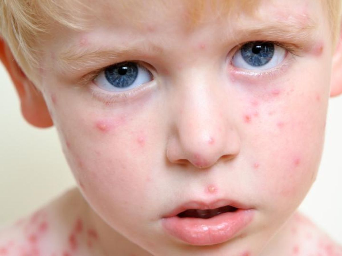 how did chicken pox get its name what does it mean and where did chickenpox come from