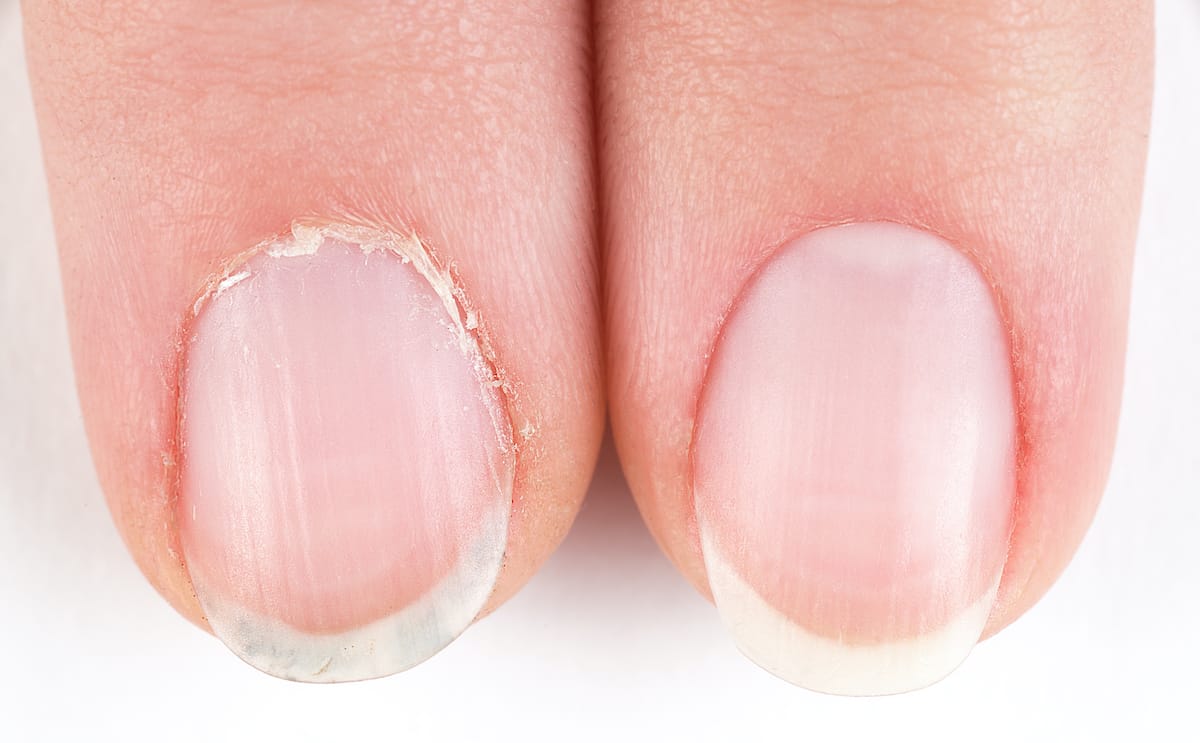 how did the word hangnail originate and what does hangnail mean