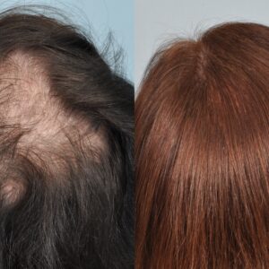 how do dermatologists transplant hair and how long does it take for the new hair to grow scaled