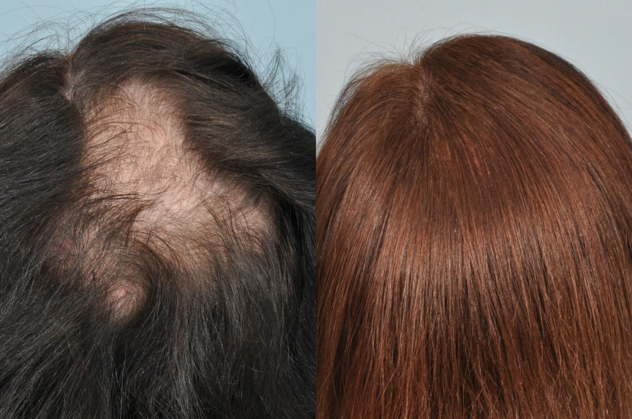 how do dermatologists transplant hair and how long does it take for the new hair to grow scaled
