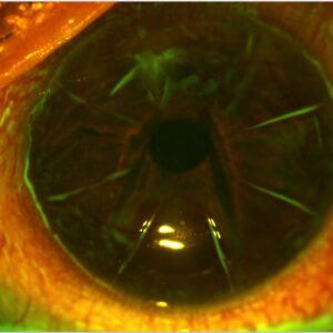 how do ophthalmologists correct nearsightedness in ten minutes with radial keratotomy
