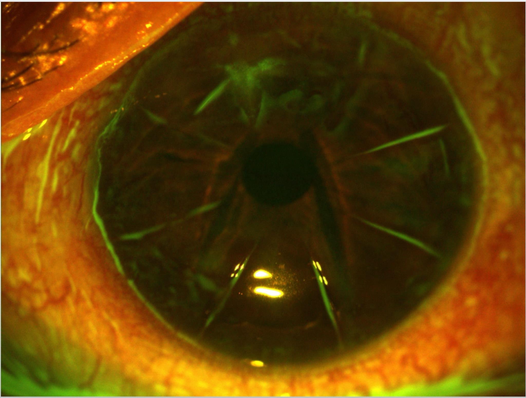 how do ophthalmologists correct nearsightedness in ten minutes with radial keratotomy