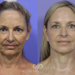 how is a face lift performed by a plastic surgeon and how long does it take