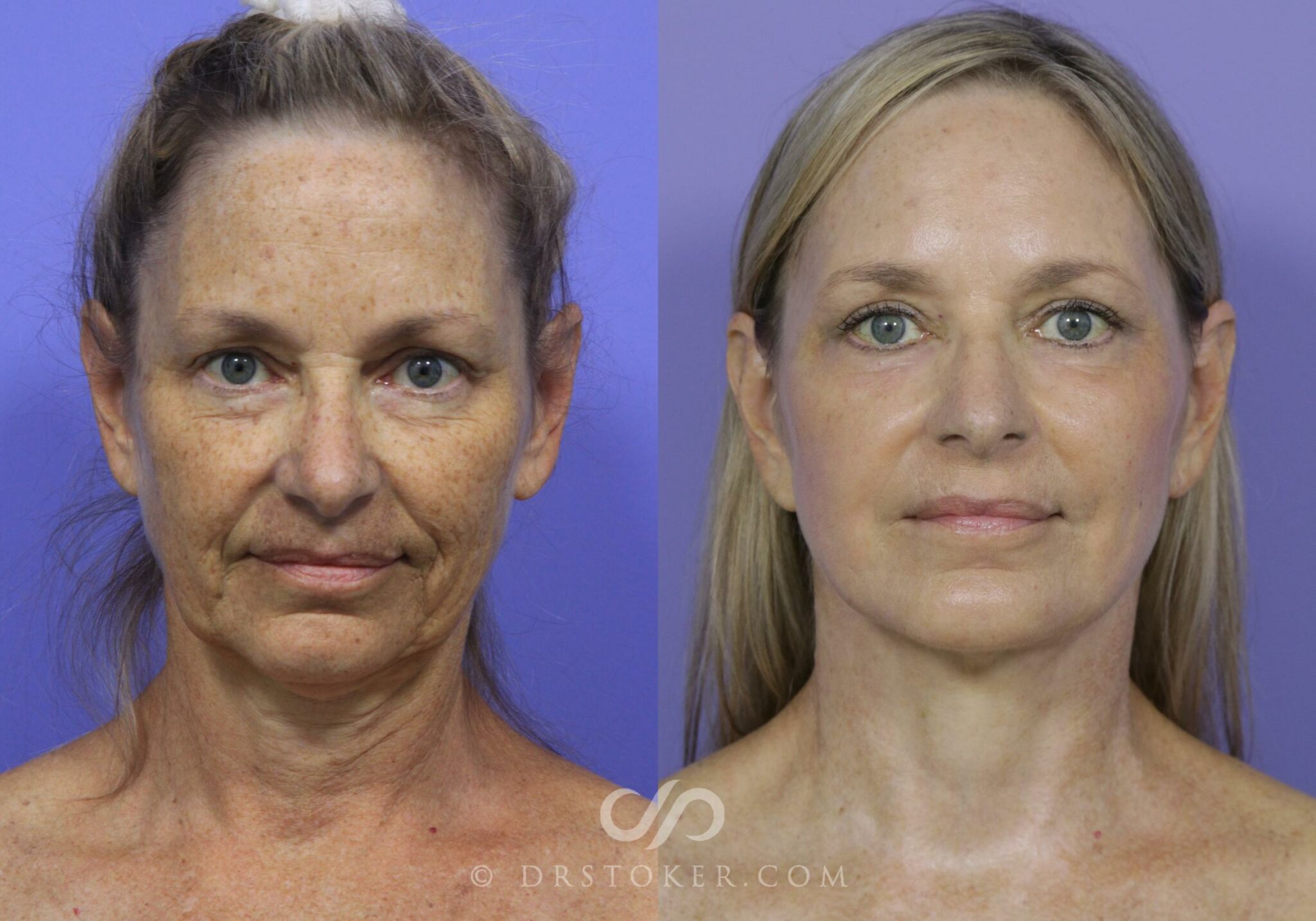 how is a face lift performed by a plastic surgeon and how long does it take