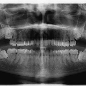 what are wisdom teeth and why do we remove them