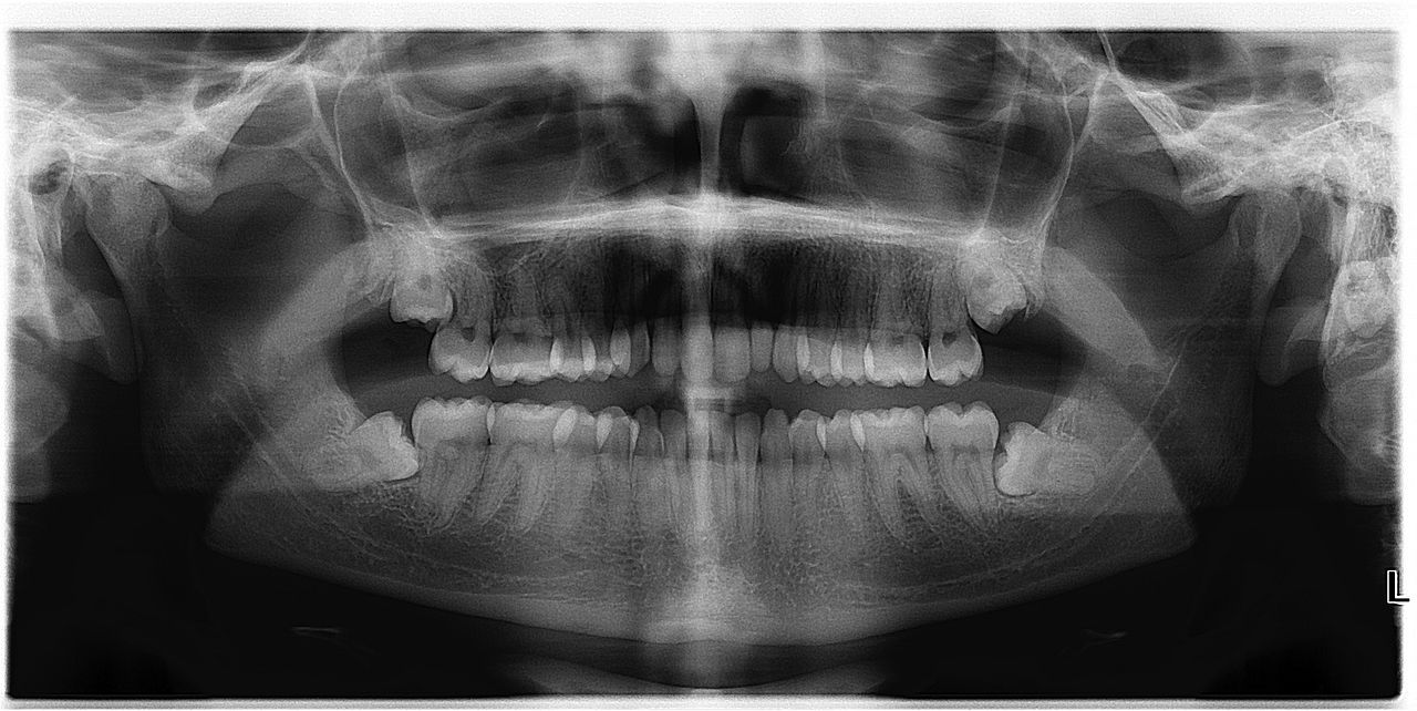 what are wisdom teeth and why do we remove them