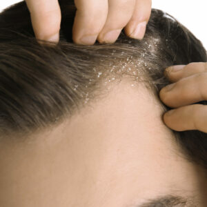 what causes dandruff where does dandruff come from and how does anti dandruff shampoo work to stop flakes
