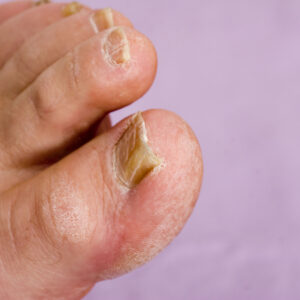 what is athletes foot what causes the fungal infection and why does it occur between the 3rd and 4th toes