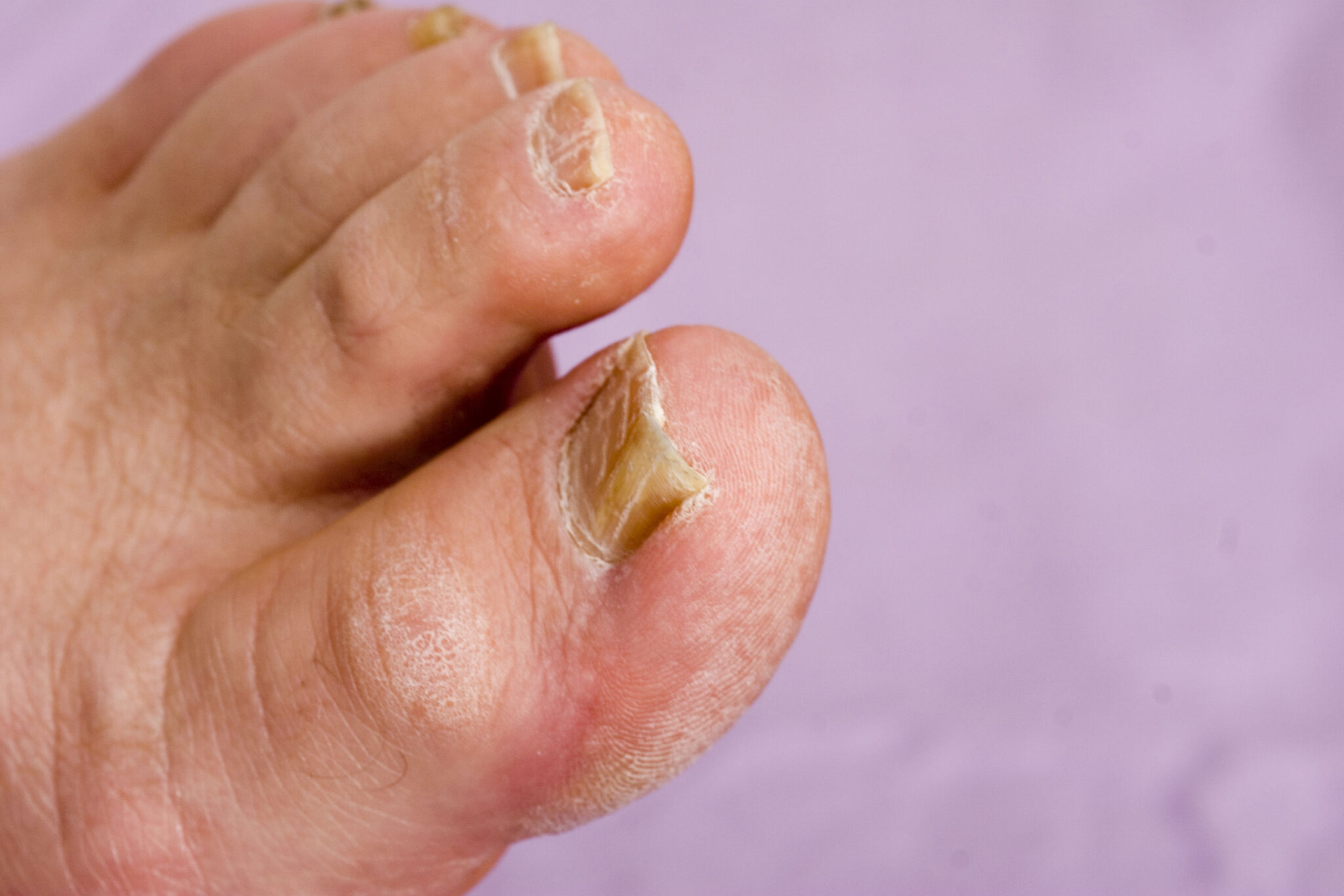 what is athletes foot what causes the fungal infection and why does it occur between the 3rd and 4th toes