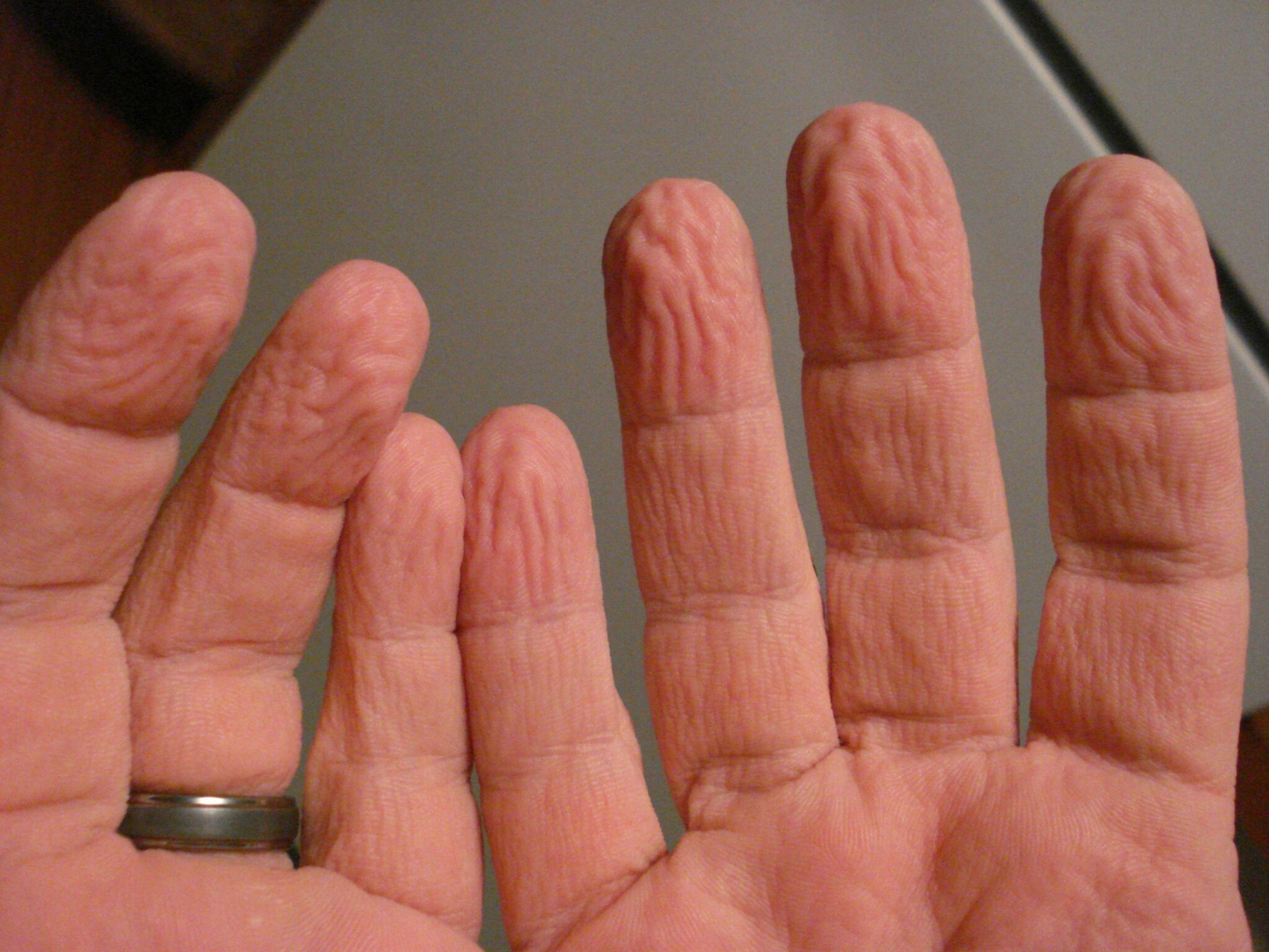 why does the skin on my fingers and toes become wrinkled after prolonged immersion in water