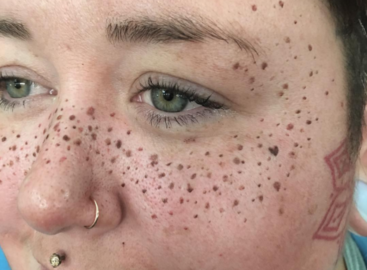 why doesnt everyone have freckles