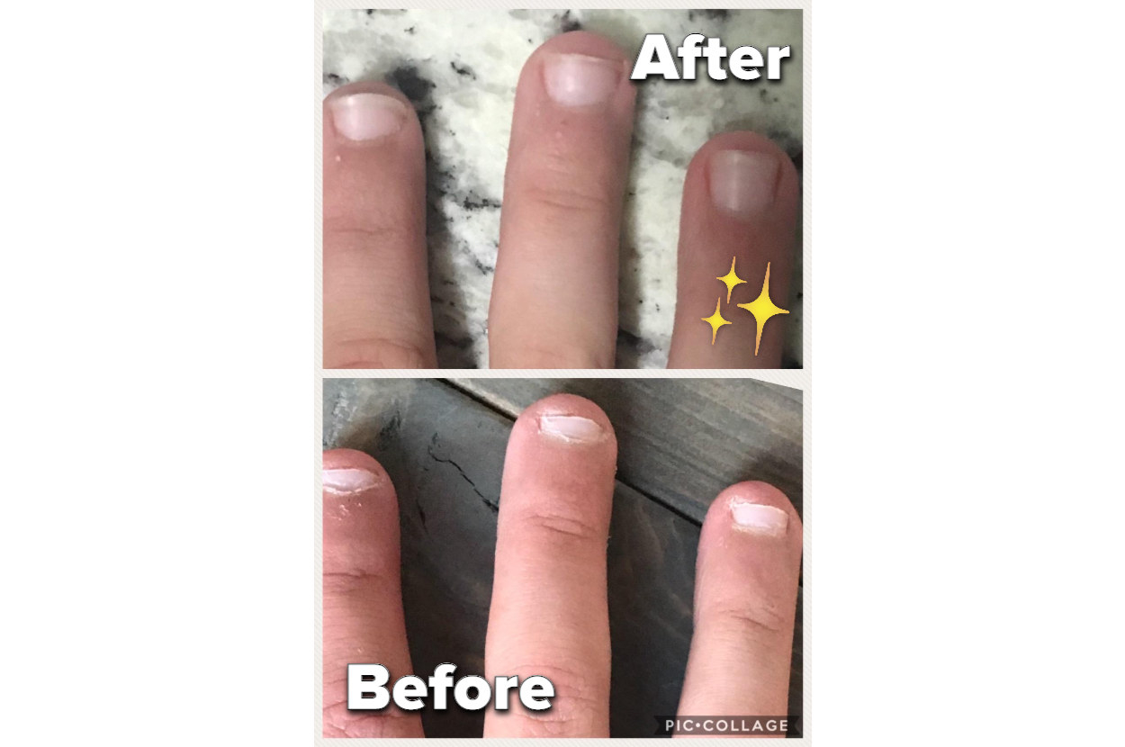 why dont your fingernails hurt when you cut or bite them