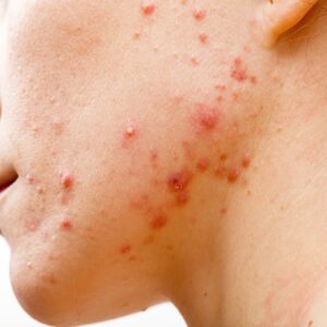 why is the bacteria that causes severe acne developing a resistance to antibiotics