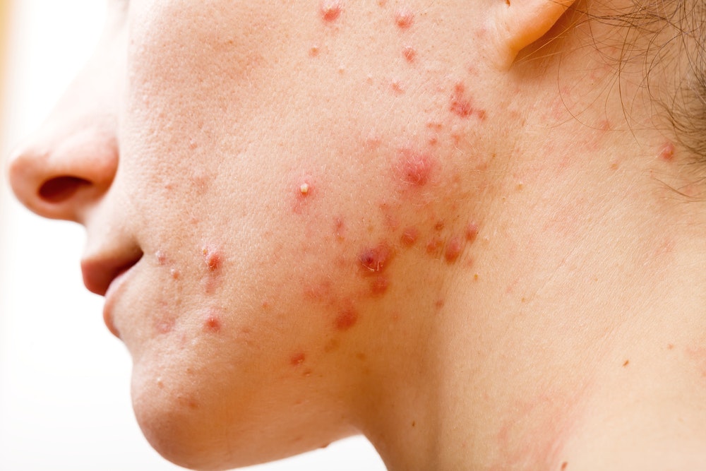 why is the bacteria that causes severe acne developing a resistance to antibiotics
